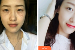 廣州新時代整形美容醫(yī)院劉曉莉整形價格表附超激光美膚祛斑案例展示