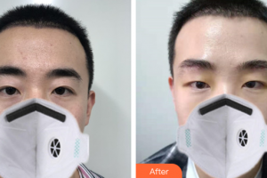 廣州曙光醫(yī)學(xué)美容醫(yī)院蔣晟整形價(jià)格表附假體墊眉弓案例展示