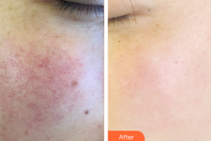 廣州曙光醫(yī)學(xué)美容醫(yī)院董沖整形價(jià)格表附美白嫩膚案例展示