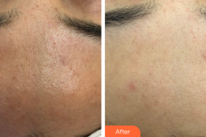 廣州曙光醫(yī)學(xué)美容醫(yī)院杜小燕整形價(jià)格表附海菲秀醫(yī)學(xué)深層清潔案例展示