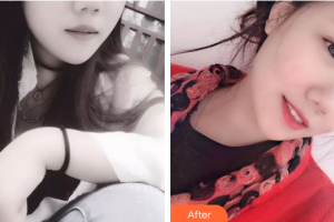 廣州曙光醫(yī)學(xué)美容醫(yī)院張昌輝整形價(jià)格表附瓷貼面案例展示