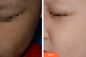 廣州曙光醫(yī)學(xué)美容醫(yī)院吳艷整形價(jià)格表附祛斑祛痣案例展示