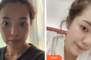 廣州曙光醫(yī)學(xué)美容醫(yī)院馬小兵整形價(jià)格表附光子嫩膚案例展示