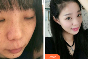 廣州曙光醫(yī)學(xué)美容醫(yī)院梁虹整形價(jià)格表附雙機(jī)祛斑案例展示