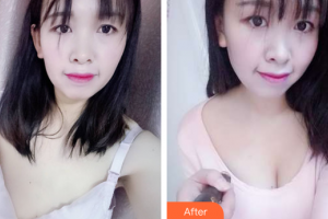 廣州曙光醫(yī)學(xué)美容醫(yī)院郭澍整形價(jià)格表附自體脂肪隆胸案例展示