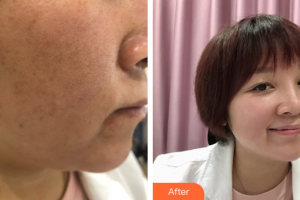 廣州曙光醫(yī)學(xué)美容醫(yī)院李利整形價(jià)格表附微針美塑案例展示