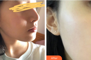 廣州華美醫(yī)療美容醫(yī)院易陽(yáng)亮整形價(jià)格表附光子嫩膚案例展示