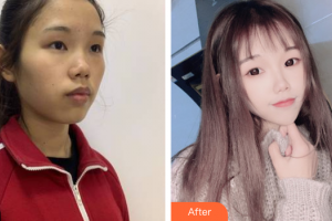 廣州曙光醫(yī)學(xué)美容醫(yī)院黃詠梅整形價(jià)格表附光子嫩膚案例展示