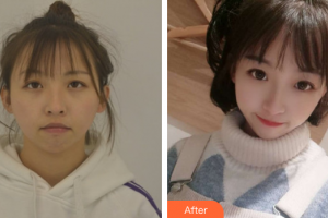 廣州華美醫(yī)療美容醫(yī)院黃承國(guó)整形價(jià)格表附下巴整形案例展示