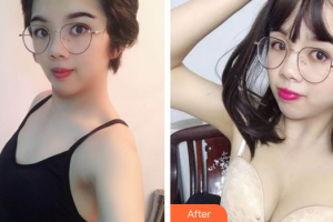 廣州華美醫(yī)療美容醫(yī)院洪永泰整形價(jià)格表附自體脂肪隆胸案例展示