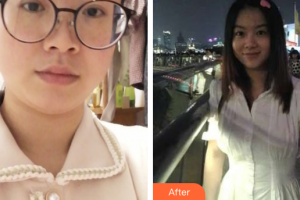 廣州華美醫(yī)療美容醫(yī)院鄭載浩整形價(jià)格表附溶脂案例展示