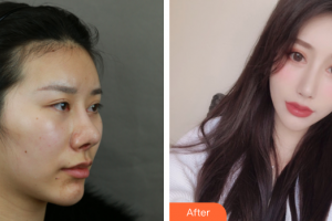 廣州華美醫(yī)療美容醫(yī)院鄭智勛整形價(jià)格表附顴骨+夾脂墊案例展示