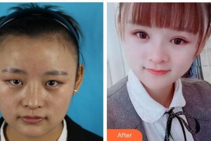 成都恩喜醫(yī)學整形美容醫(yī)院張曉琴整形價格表附眼部手術案例展示