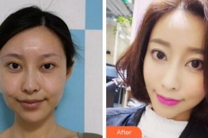 成都素美醫(yī)療美容診所余平清整形價格表附埋線提升案例展示