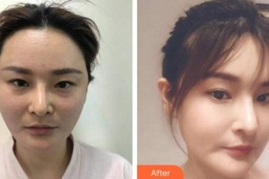 成都艾美醫(yī)療美容門診部徐乙茹整形價格表附埋線提升案例展示