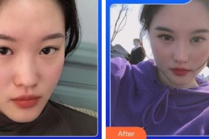 成都恩喜醫(yī)學整形美容醫(yī)院李光虎整形價格表附5S重瞼術+超微創(chuàng)開內(nèi)眥案例展示