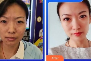 成都素美醫(yī)療美容診所楊華博整形價格表附5s重瞼術+超微創(chuàng)開內(nèi)眥案例展示