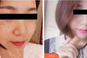 成都素美醫(yī)療美容診所陳丹整形價格表附激光去黃褐斑案例展示