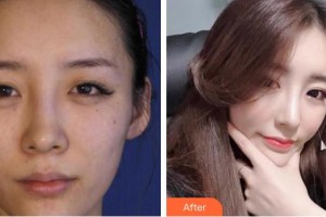 成都花田醫(yī)療美容門診部陳剛整形價格表附水光案例展示