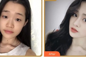 成都百齡駐顏醫(yī)學美容門診部肖凌整形價格表附鼻部綜合案例展示