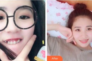 成都醫(yī)美整形美容醫(yī)院柳媛媛整形價格表附牙齒矯正案例展示