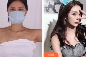 成都百齡駐顏醫(yī)學美容門診部李文祥整形價格表附手臂吸脂案例展示