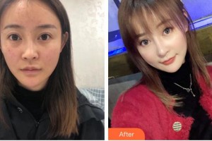 成都維度醫(yī)療美容診所周維整形價格表附鼻部手術-鼻頭大 山根低案例展示