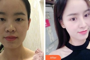 成都艾尚醫(yī)學美容門診部秦虹整形價格表附鼻部綜合案例展示