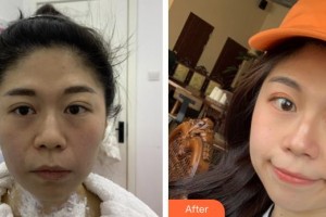 成都美極醫(yī)療美容門診部屈武整形價格表附熱瑪吉抗衰案例展示