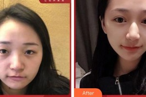 成都美極醫(yī)療美容門診部劉大琨整形價格表附切開雙眼皮案例展示