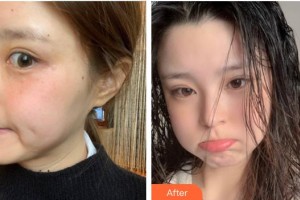 成都嬌點(diǎn)醫(yī)學(xué)美容醫(yī)院孫葉培整形價(jià)格表附激光美膚激光案例展示