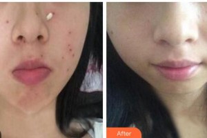 成都濟(jì)慈德美醫(yī)療美容門診部鄭光靜整形價(jià)格表附激光點(diǎn)痣案例展示