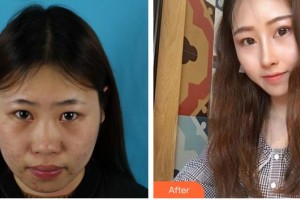 成都市錦江區(qū)第二人民醫(yī)院醫(yī)學(xué)美容科王嘉勛整形價(jià)格表附鼻整形案例展示