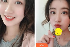 成都元辰醫(yī)學(xué)美容門診部巫國輝 整形價(jià)格表附面部填充案例展示