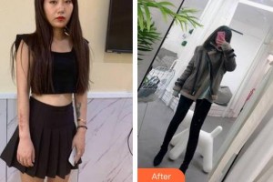 成都青羊區(qū)第五人民醫(yī)院疤痕科陳玉龍整形價(jià)格表附手術(shù)疤痕案例展示