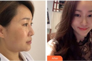 成都嬌點(diǎn)醫(yī)學(xué)美容醫(yī)院韓飛整形價(jià)格表附EDS中下面部提升案例展示