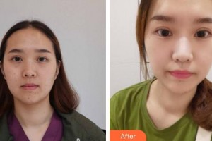 成都泊菲凱莉醫(yī)學(xué)整形美容醫(yī)院任小東整形價(jià)格表附褐青色痣案例展示