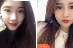 成都百齡駐顏醫(yī)學(xué)美容門診部劉祎整形價(jià)格表附雙眼皮 眼部手術(shù)案例展示