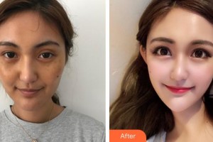 成都菲格醫(yī)療美容門診部陳謝娟整形價(jià)格表附超激光美膚祛斑案例展示