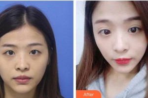 成都晶膚醫(yī)學(xué)美容醫(yī)院鄭勝國整形價(jià)格表附不開刀雙眼皮案例展示