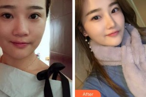 成都正好醫(yī)學(xué)美容門診部王卓璽整形價(jià)格表附鼻部手術(shù)案例展示