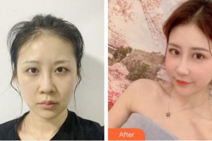 成都唯羅納醫(yī)療美容門診部高海燕整形價(jià)格表附鼻部手術(shù)案例展示