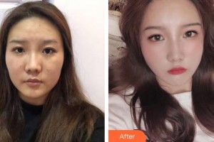 成都黃氏百佳整形醫(yī)院顏明輝整形價(jià)格表附埋線提升提升案例展示