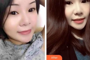 成都明星醫(yī)療美容門診部譚貴苗整形價(jià)格表附眼部綜合案例展示