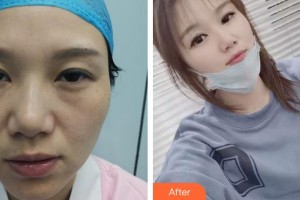 成都柏菲絲醫(yī)學(xué)美容門診部蘇瑋智整形價(jià)格表附面部吸脂案例展示