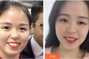 成都景華醫(yī)學(xué)美容門診部華越整形價(jià)格表附牙綜合案例展示