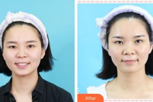 成都百齡駐顏醫(yī)學(xué)美容門診部張美琳整形價格表附激光美膚祛斑案例展示