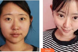 成都度曼美醫(yī)療美容診所奉龍整形價格表附切開雙眼皮案例展示
