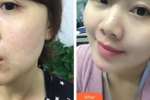 成都百齡博雅醫(yī)學(xué)美容醫(yī)院謝靈婕整形價格表附面部提升案例展示