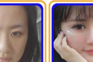 成都如悅醫(yī)療美容醫(yī)院徐進(jìn)整形價格表附眼部手術(shù)+脂肪案例展示